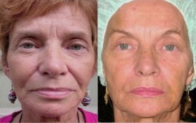 ENDOPEEL, il lifting chimico del viso senza chirurgia - STUDIO MEDICO DOTT. ZUNICA
